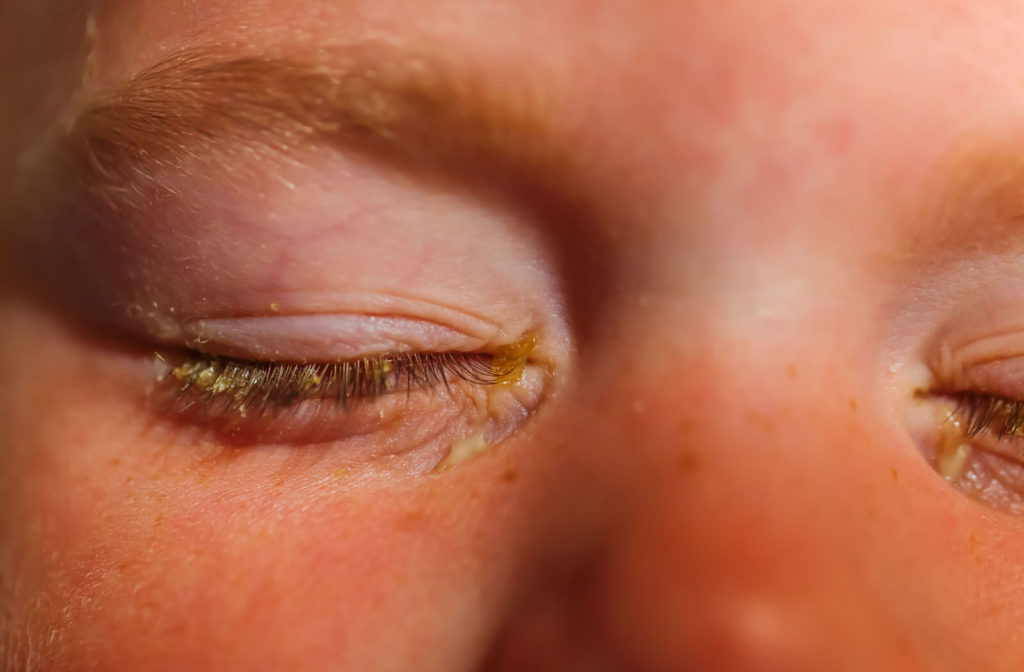A close-up of a child's closed eyes with conjunctivitis with mucus build up.