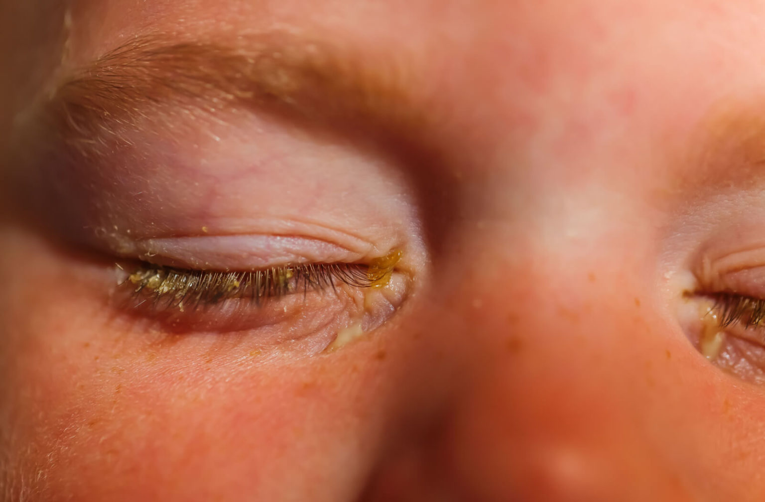 Pink Eye Vs. Allergy Symptoms | Total Vision La Mesa