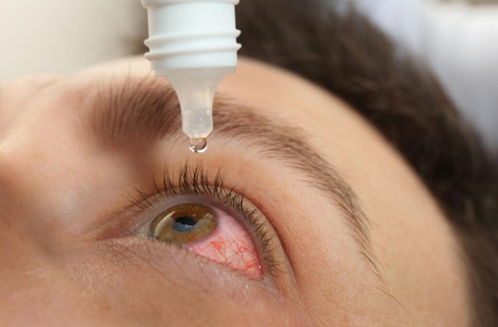 A close up of someone with pink eye inserting eye drops.